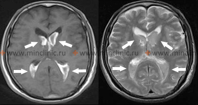 MRI of the brain the patient with hemorrhage into the ventricles of the brain during Moyamoya disease. The cavity of the lateral ventricles filled with blood (indicated by arrows).